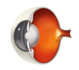 Cataract Diagram